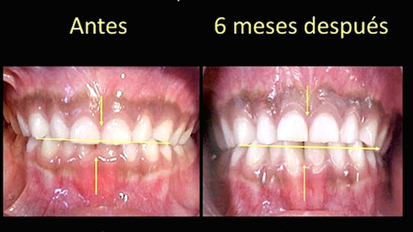 Evolución del tratamiento miofuncional postural con los sistemas de MRC (2)