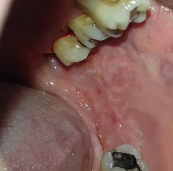 Fig. 1 - Reazione lichenoide da contatto della mucosa orale con l’amalgama.