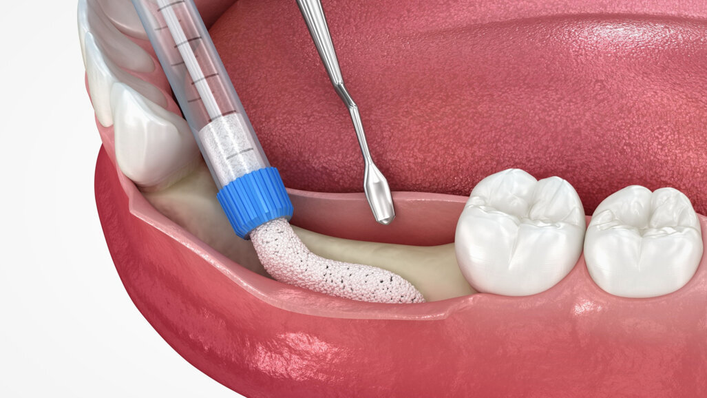 Webinar to focus on peri-implant tissue augmentation and maintenance