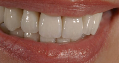 The new NobelProcera system for clinical success: The next level of CAD/CAM dentistry