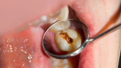 Could zinc make cavity treatment simpler, painless and drill-free?