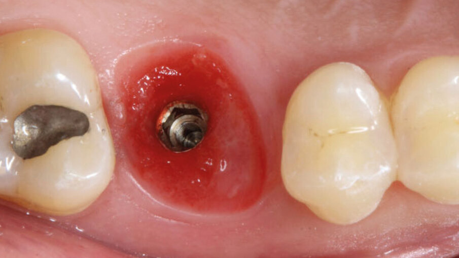 Fig. 9 - Guarigione a 3 mesi.