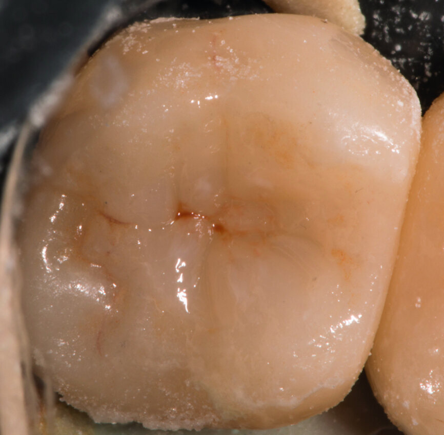 Fig. 15 : Restauration par Essentia Universal. 
