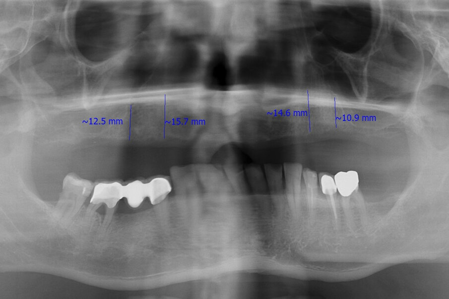 Fig. 2: Pre-op radiograph.