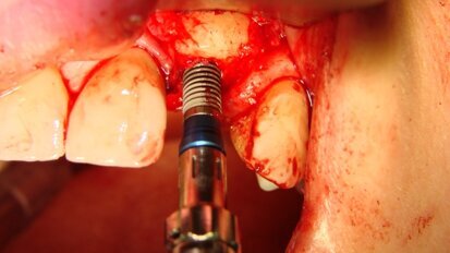 Rekonstrukcja blokiem allogennym wyrostka zębodołowego w okolicy 22 i wszczepienie implantu BEGO Semados S