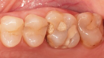 Лечение с Bio-Bulk fill при дълбоки кариеси