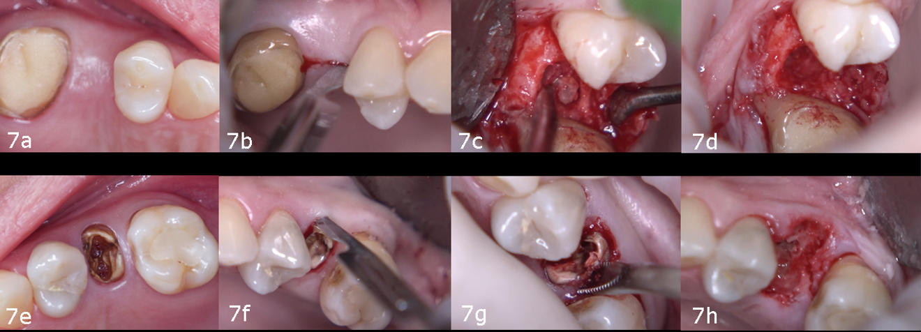 Figs. 7a–h: Full-thickness flap and extraction in site #15 (a–d), and flapless extraction in site #25 (e–h).