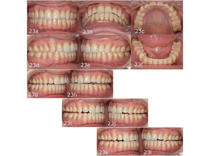 Figs. 23a–l: Situation at the end of the second phase of aligner treatment. Stable occlusion and correct excursive movements. (a–f) Orthopaedic stability. (g & h) Right lateral excursion. (i & j) Protrusion (k & l) Left lateral excursion.