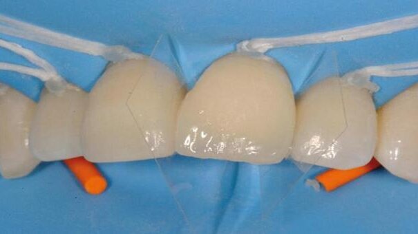 Simple layering technique with direct composite restorations