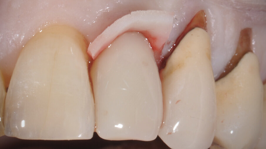 Fig. 7_Provvisorio in sede con matrice dermica suina esposta.