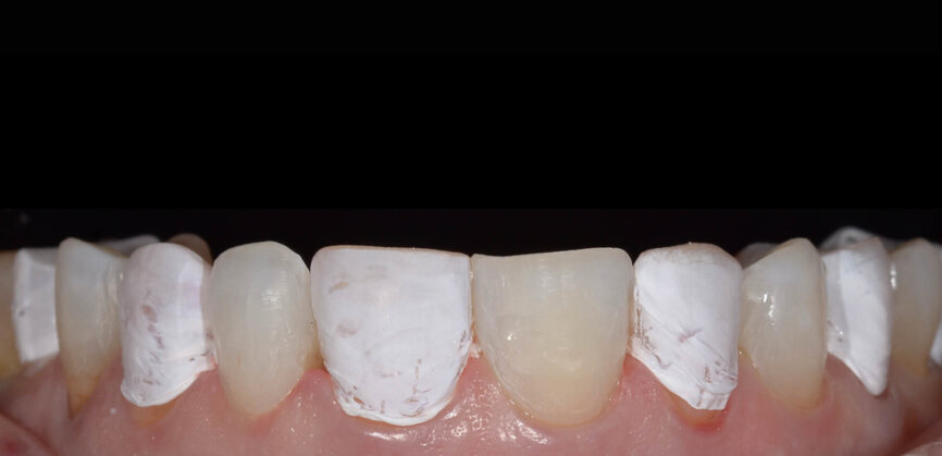 Fig. 5: PTFE tape was used to separate the teeth. 