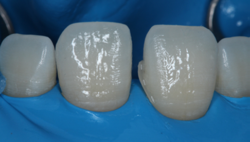 Fig. 10: Correction to the size of the 1st tooth