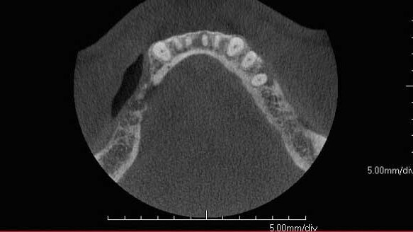 Edentulous patients can benefit from the integration of CBCT data