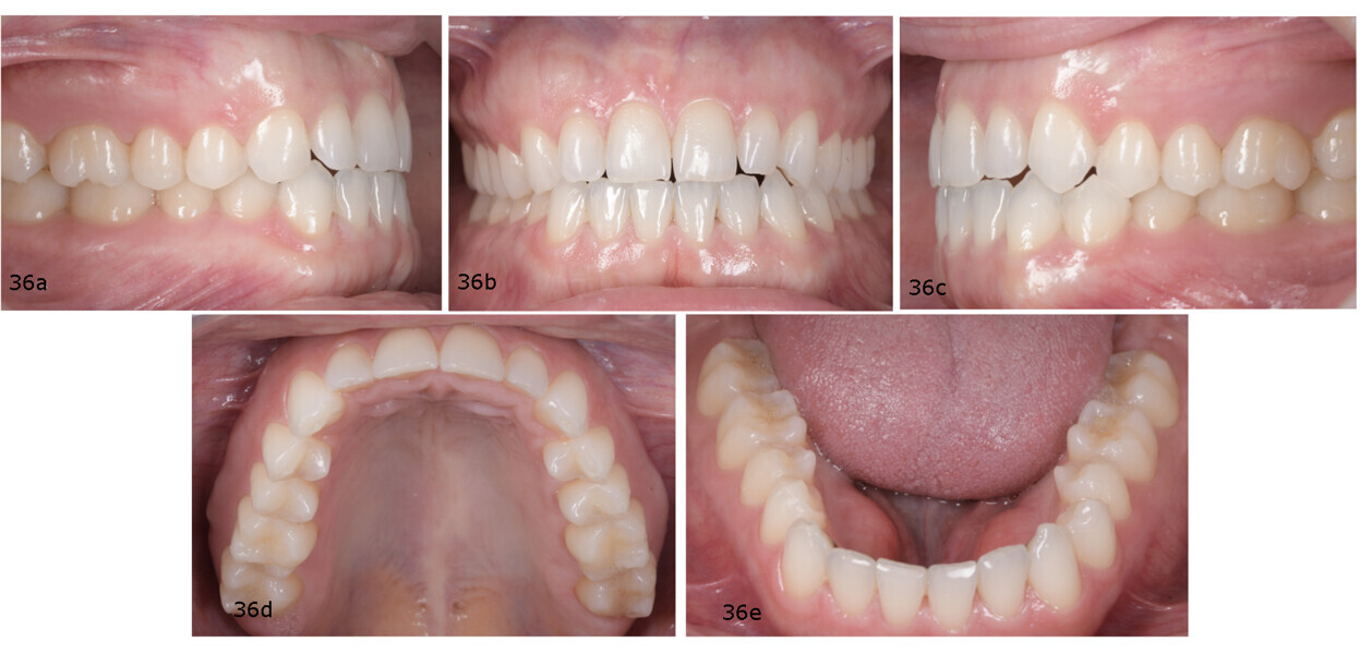 Figs. 36a–e: Pretreatment intra-oral photographs.