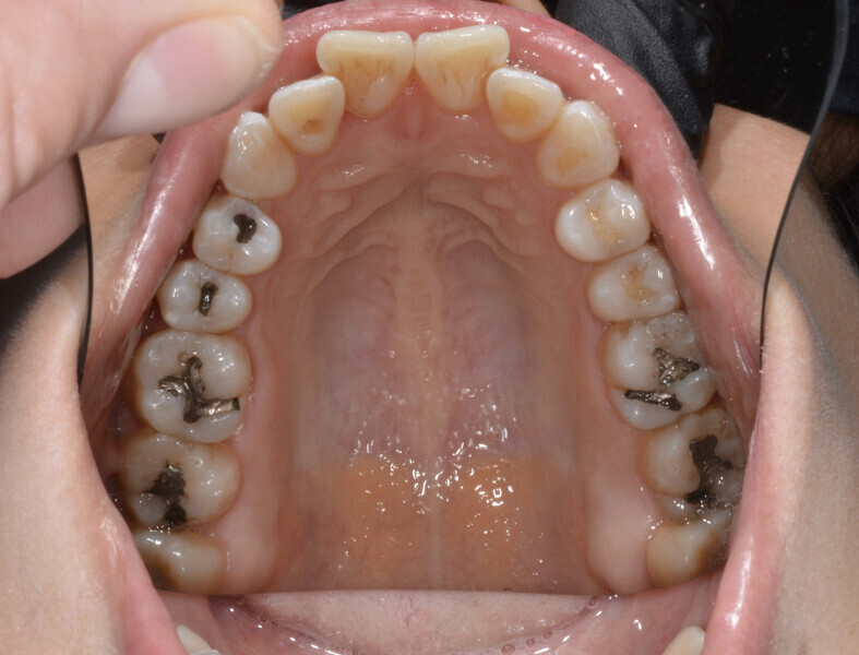Fig. 3a: Initial occlusal photograph.