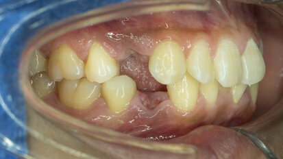 What to consider when caring for partially dentate patients