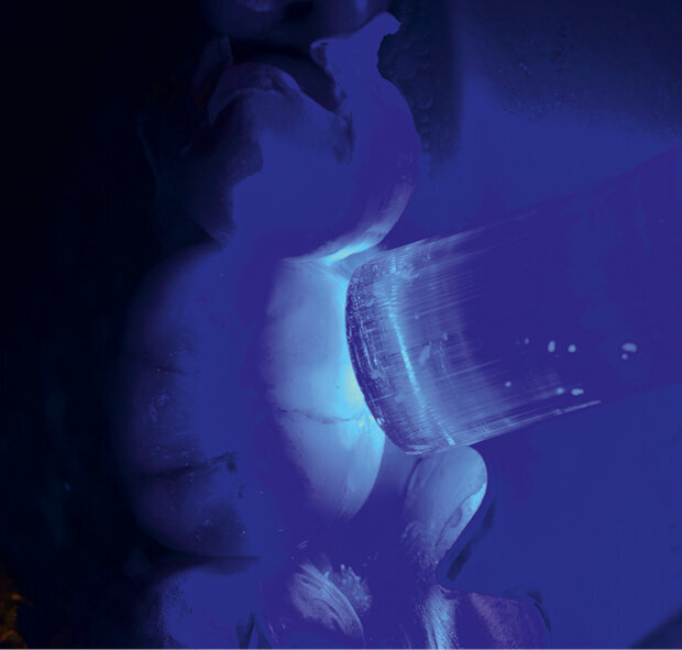 Fig. 10: Final curing. Excess luting material was removed beforehand (quarter technique)