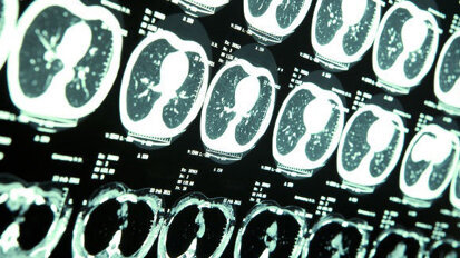Dentale röntgenfoto’s verhogen risico op goedaardige tumor