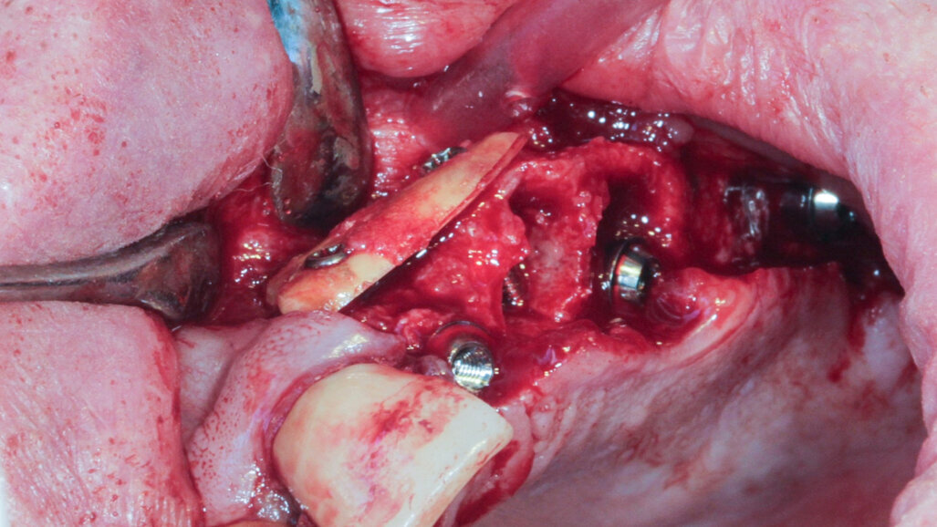 Radicular transplantation—The use of dental roots in the treatment of bone insufficiency