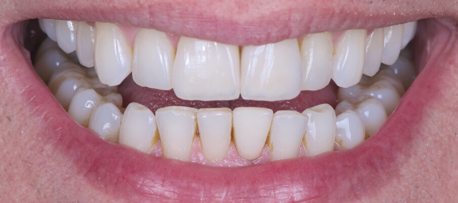 Fig. 13: Harmony in shade and shape: Both upper anteriors appear significantly stronger and have the desired lighter tooth shade.