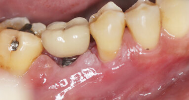 Peri-implantitis second most common complication following dental implant therapy