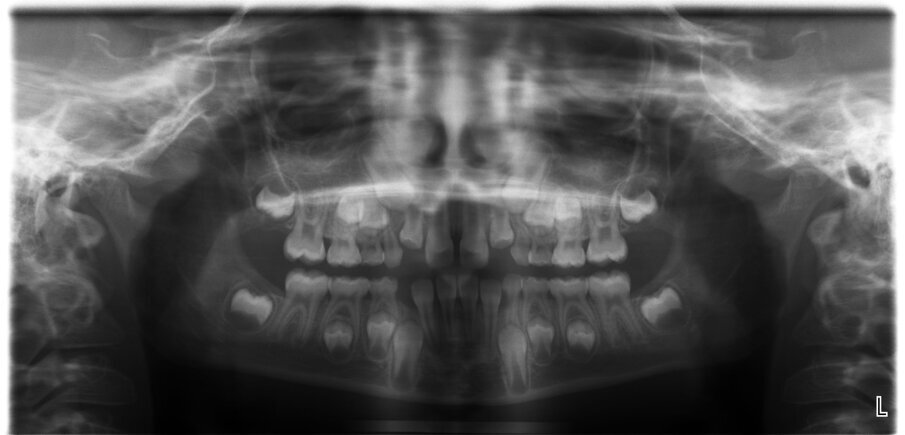 Fig. 3_Ortopantomografia iniziale.
