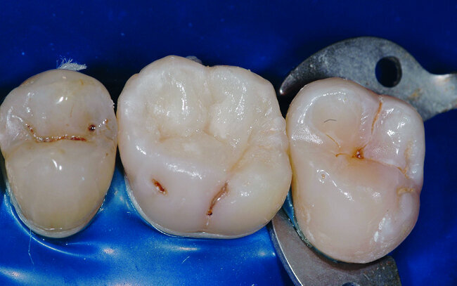Fig. 28: Vue clinique objectivant l’anatomie dentaire recréer par l’apport successif d’incrément de composite. 