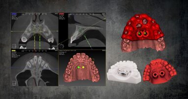 Orthodontic appliances on temporary anchorage devices: Single-stage procedure