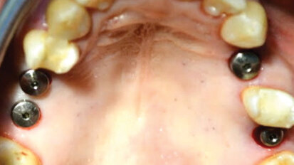 Safe, accurate, simplified sinus-lift technique for general practitioners, Part 2: Introduction of surgical technique