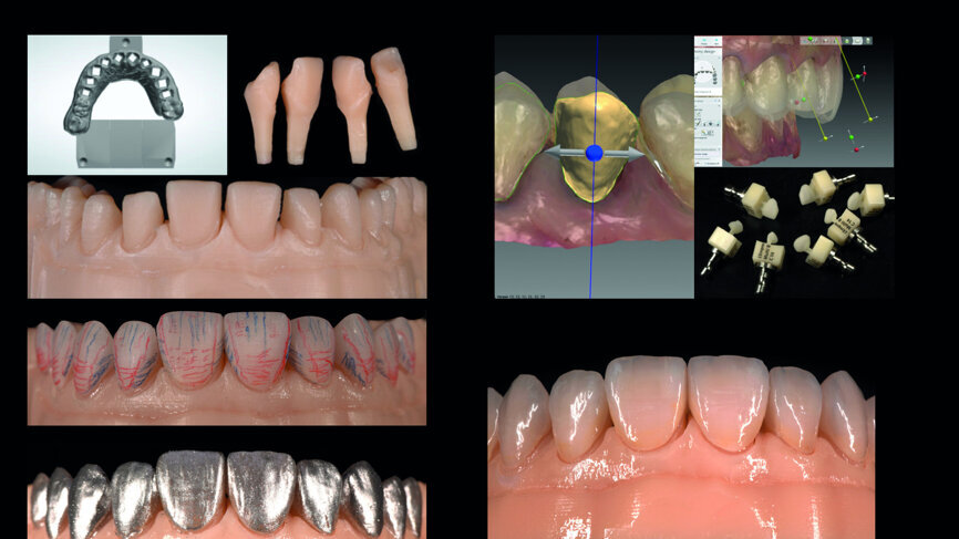 Fig. 14: Digital workflow (3-D printed model, CAD/CAM veneers, adjustments, staining/glazing).