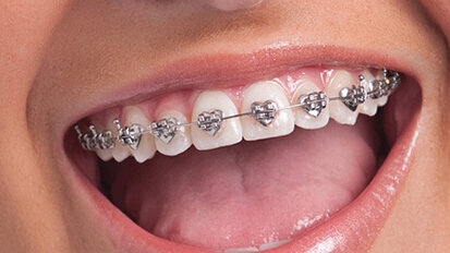 Kids can go ‘wild’ for multi-shaped braces