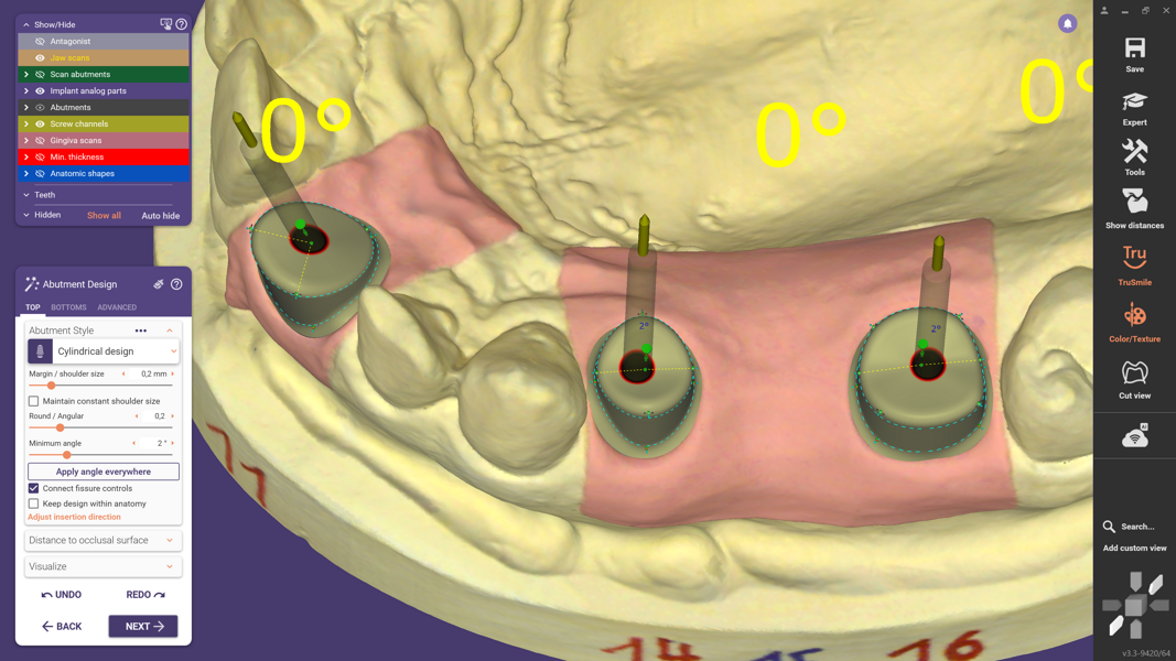 Fig. 7: Based on tooth position, the initial abutment shape is generated automatically and refined using individually adjustable control points.