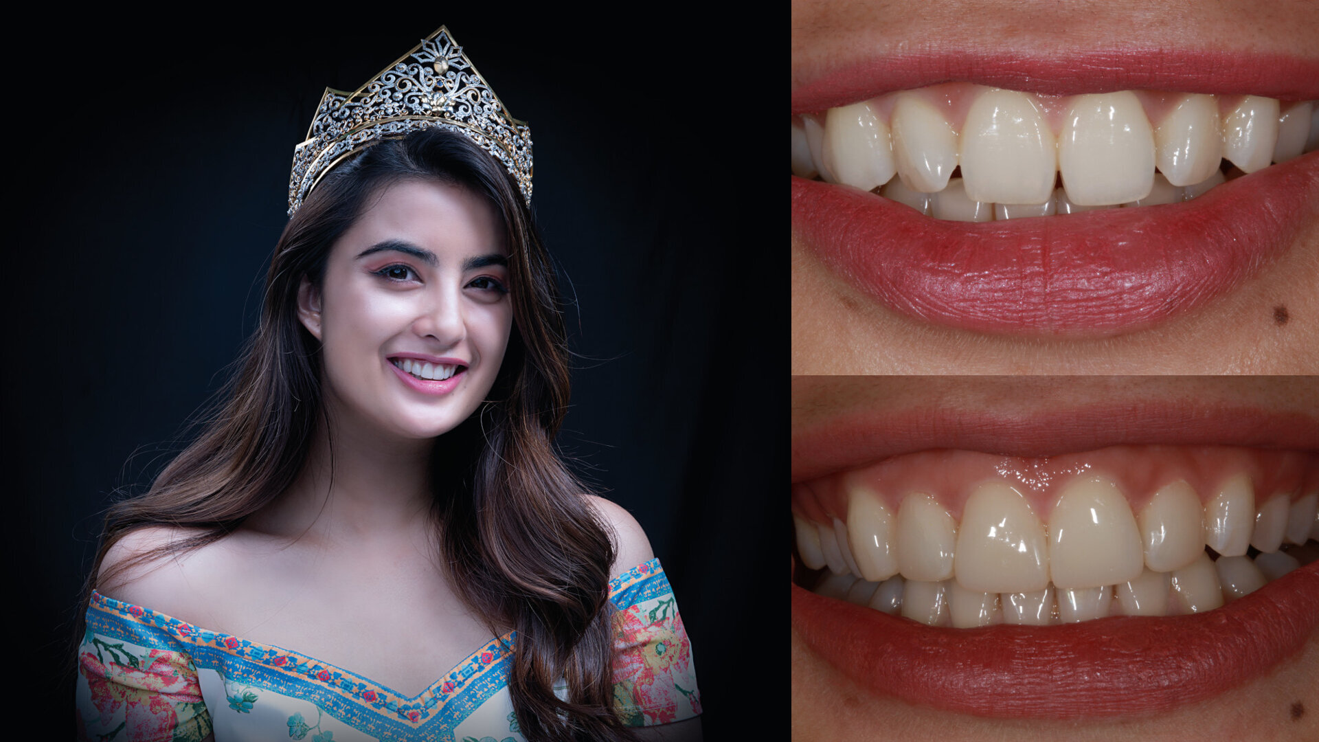 Celebrities’ Smile Makeup—the MiCD way
