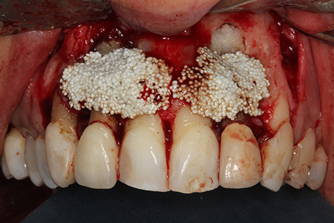 Figura 9. Aspecto clÃ­nico tras la colocaciÃ³n de injerto. En la zona apical especÃ­ficamente se colocan esponjas de colÃ¡geno para no interferir en el control radiogrÃ¡fico.