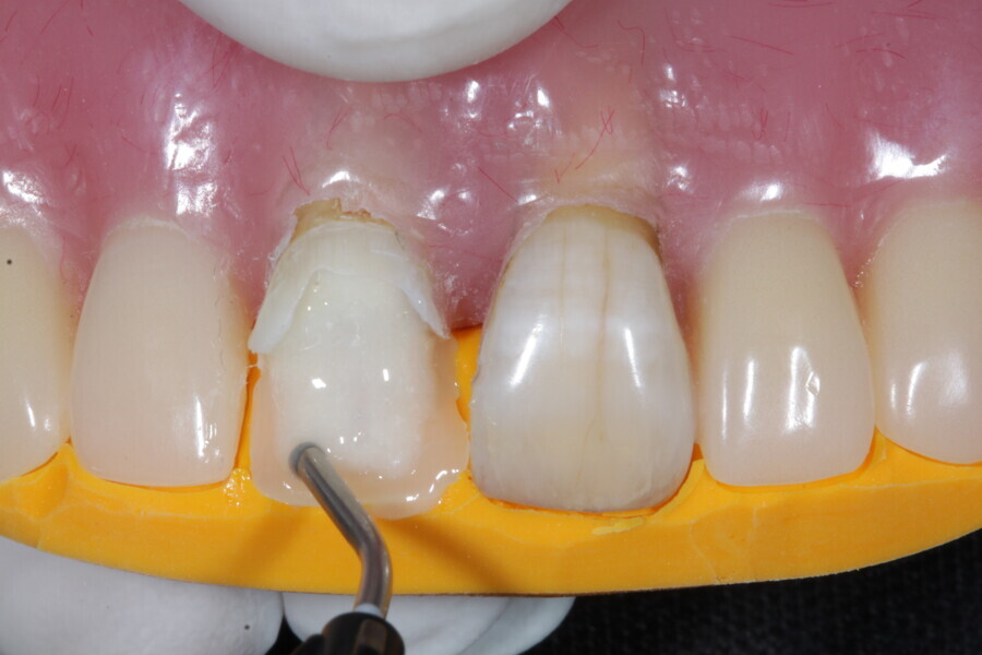 Fig. 15: The coronal portion of the micro-posts is fully covered with a fibre-reinforced flowable composite (Fibrafill FLOW).