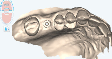 Scan, design and print: A complete digital workflow for implant-supported hybrid composite restorations