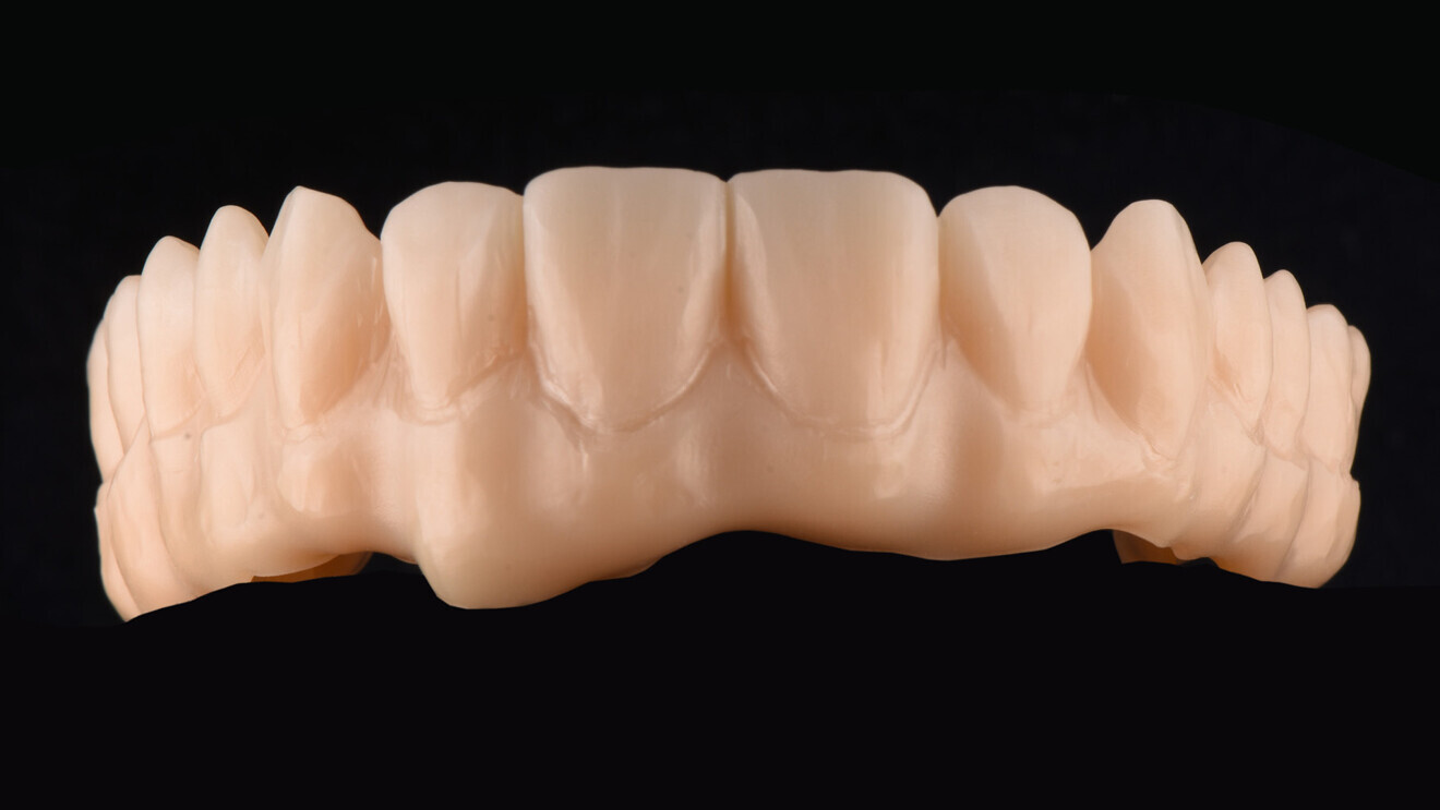 Fig. 2: Frontal view of the milled and sintered screw-retained implant-supported prosthesis. 