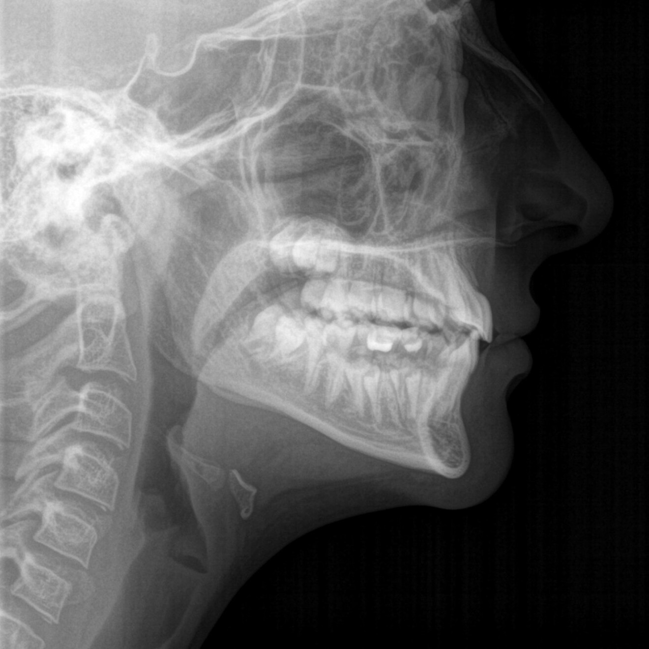 Fig. 3b: Post-treatment cephalometric radiograph. 