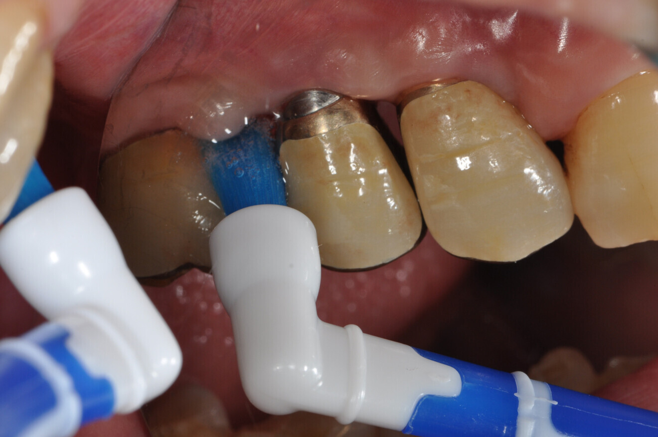 Using a Perio Brush (GC Korea) to perform TBI on swollen gingiva around an implant.