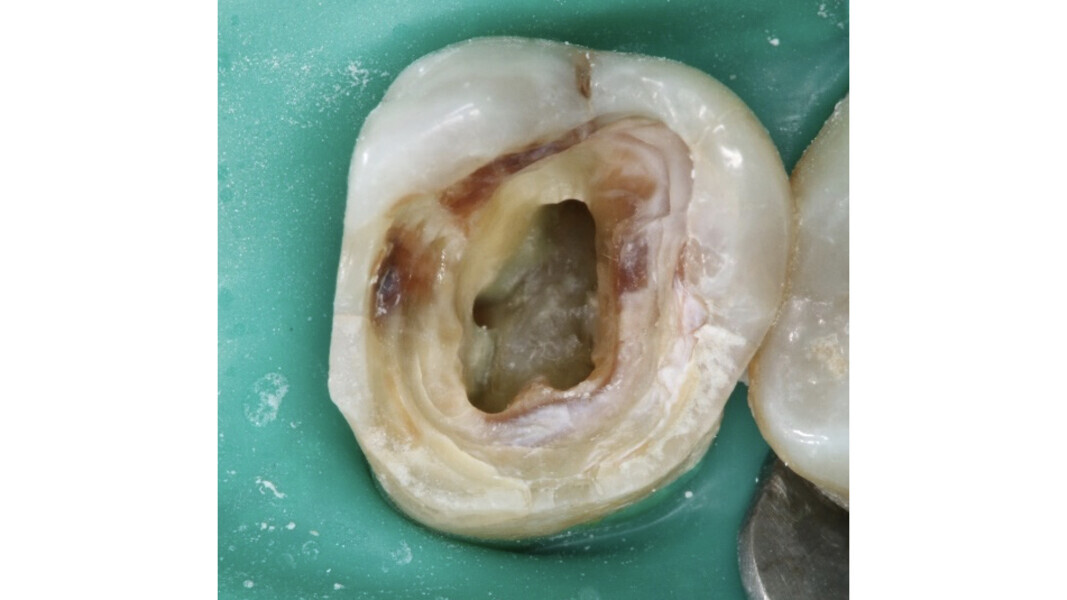 Fig. 25 : Aspect de la cavité pulpaire après mise en forme et nettoyage des canaux radiculaires : il faut noter l’opacité typique du plancher sans la moindre calcification.