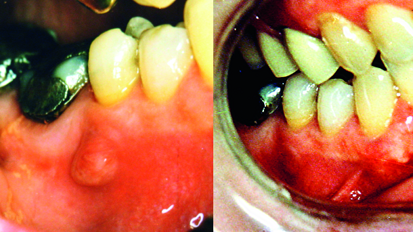 Long-term analysis of primary, non-surgical root canal treatments – A retrospective study