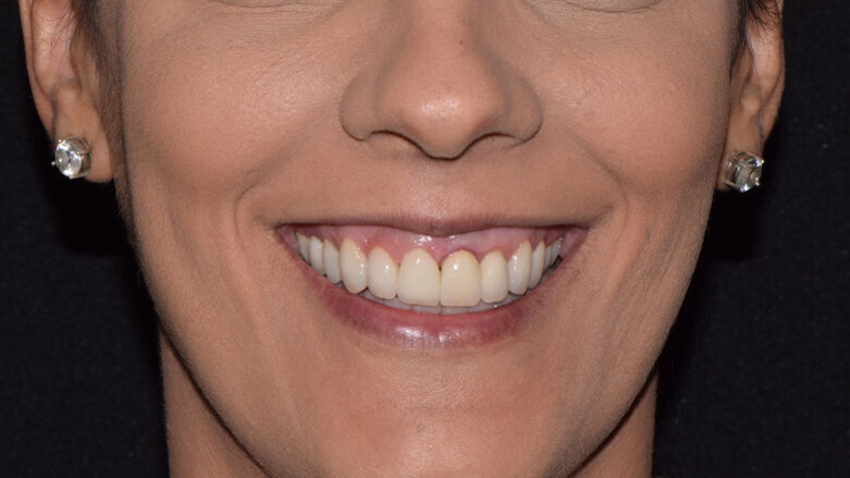Estética dinámica en la sonrisa gingival con Botox