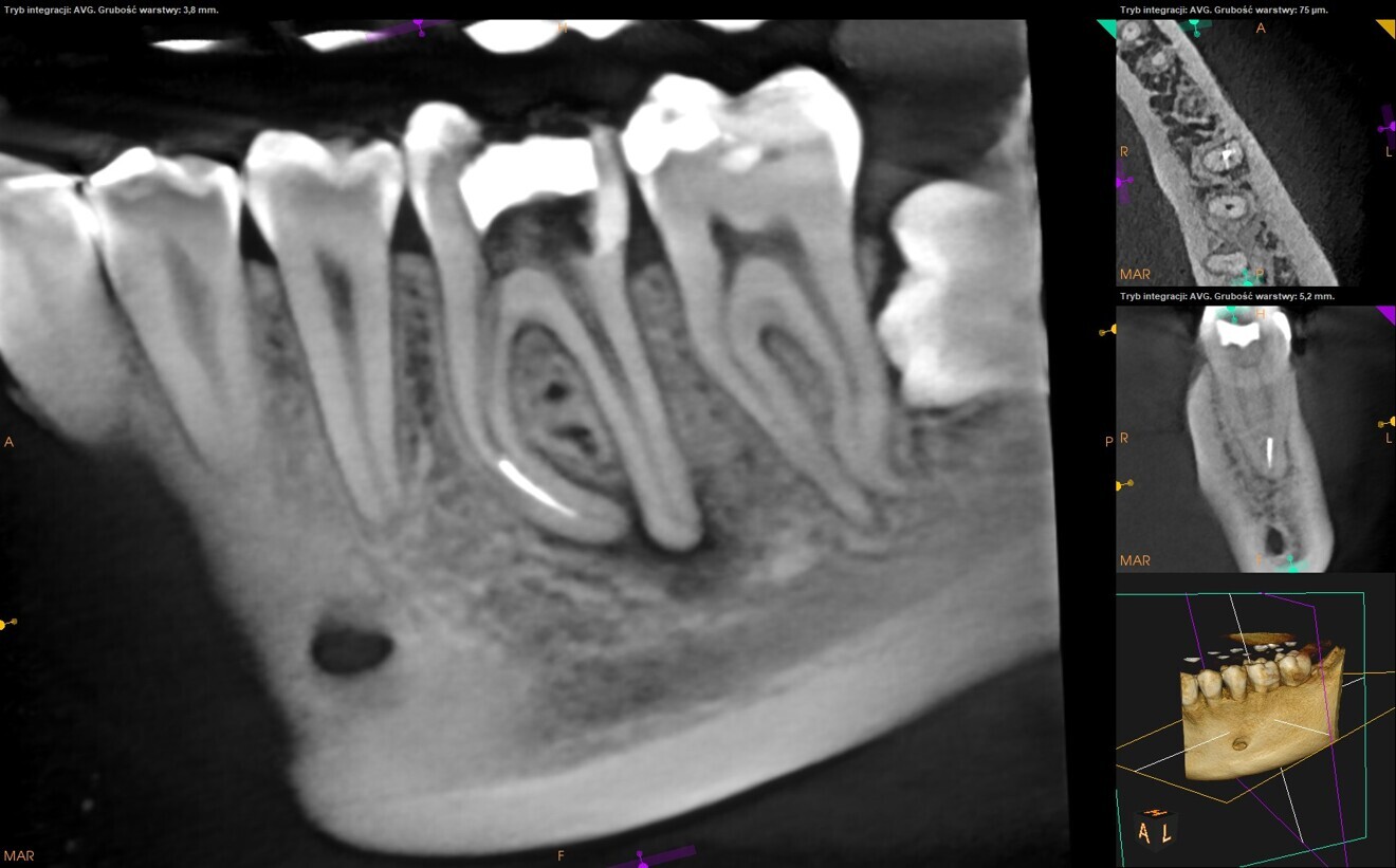 Fig. 2: Pre-op CBCT scan. Broken file far beyond the canal curvature.