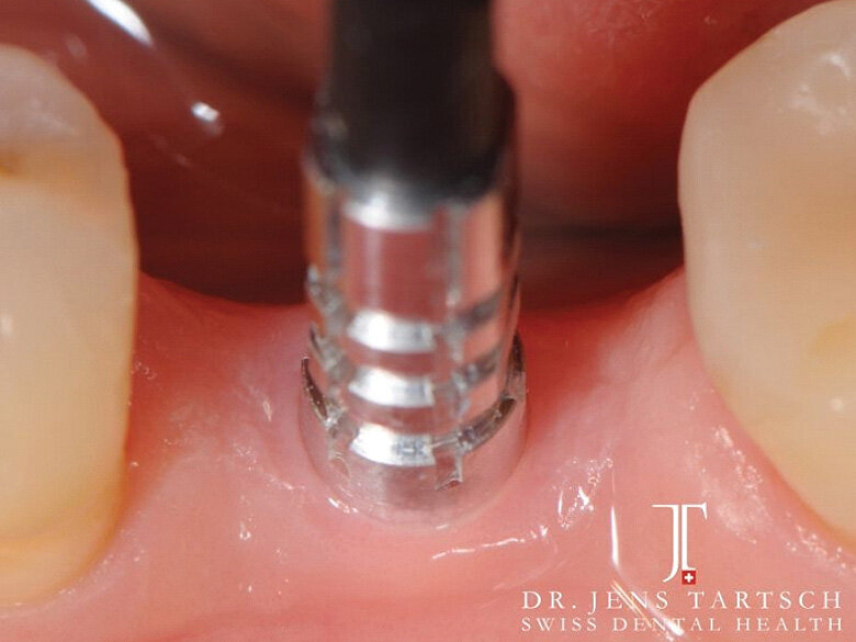 Fig. 9: Precise impression with open tray. (Photo: Jens Tartsch, DMD)