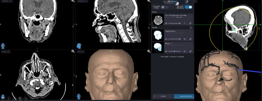 Fig. 4: StealthStation S8 matches the CT imaging with the patient’s actual anatomy.