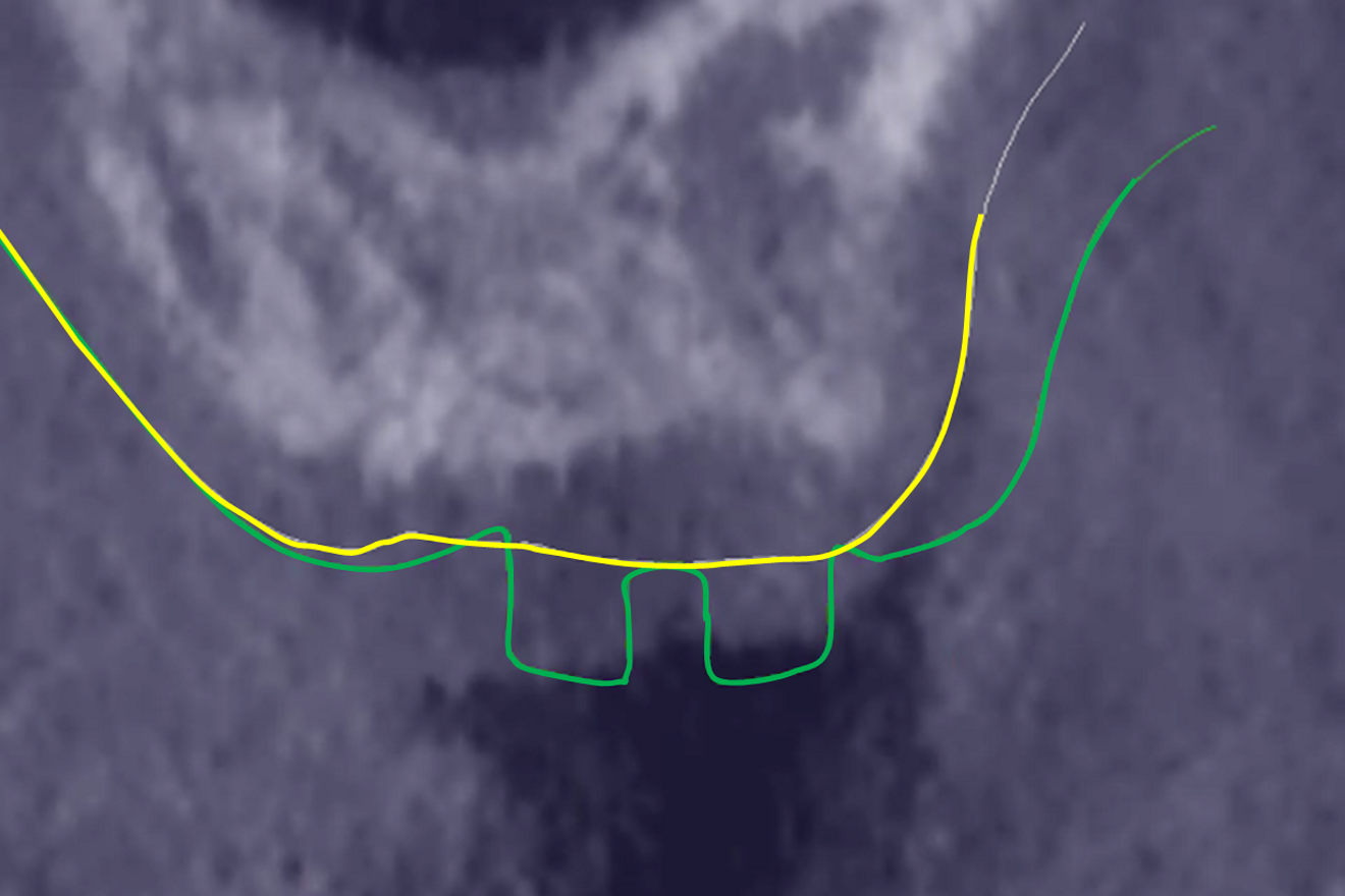 Fig. 4a: Implementation of the enhanced merging methodology at the end of the soft-tissue healing. Superimposition of the intra-oral scan taken before surgery (yellow line) and the one taken at soft-tissue healing (green line). In all the following figures the bony background of the CBCT is the one obtained before surgery; it is not representative of the crestal bone situation afterwards.