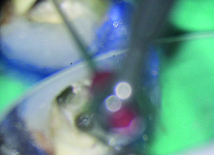 Figs. 7a et b : Création d’un espace autour du segment coronaire de l’instrument fracturé avec SONICflex Quick 2008 L muni d’un insert Endo Clean de taille 25.