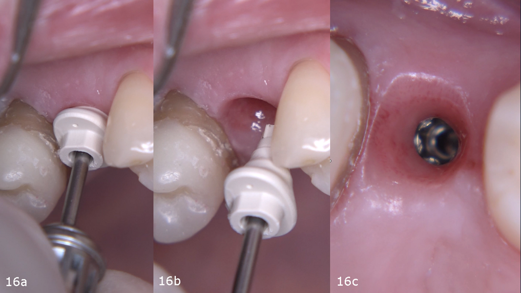 Figs. 16a–c: Outstanding soft-tissue healing at site #15 after abutment removal.