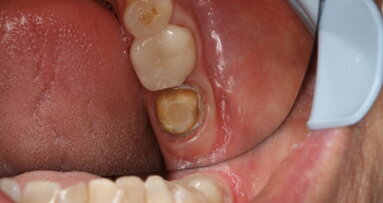 Scan perfectly with CEREC Primescan and gain time for what is really important: your patients