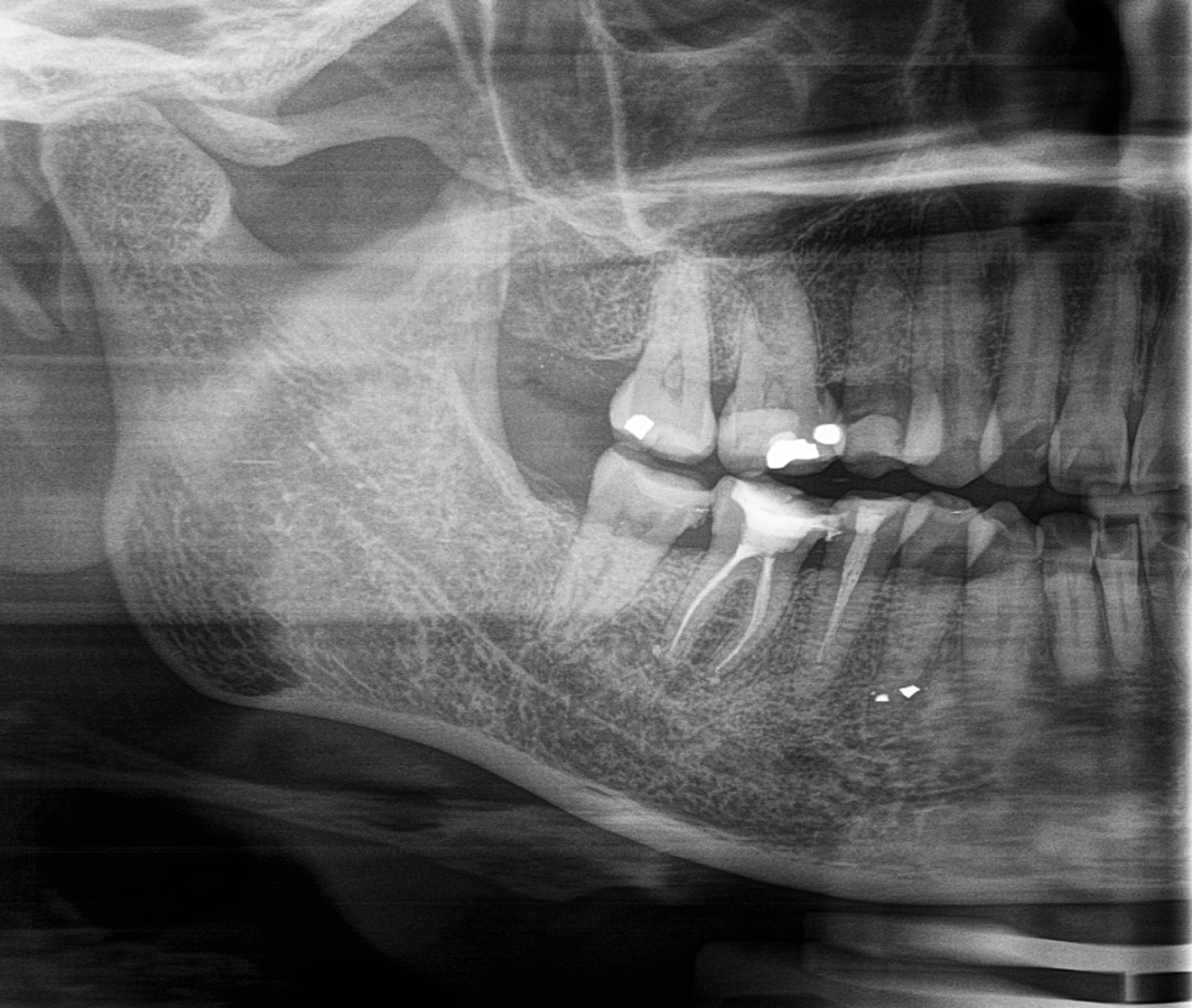 Fig. 4: Post-op radiograph showing the temporary filling.